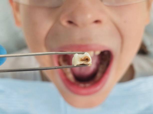 Best Emergency Wisdom Tooth Extraction in Tybee Island, GA